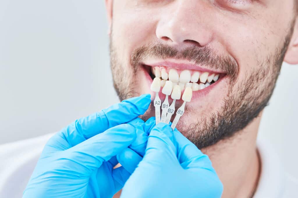 Composite Bonding