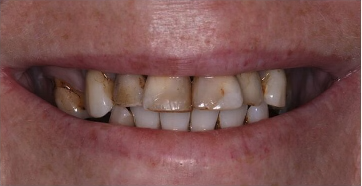 After treatment