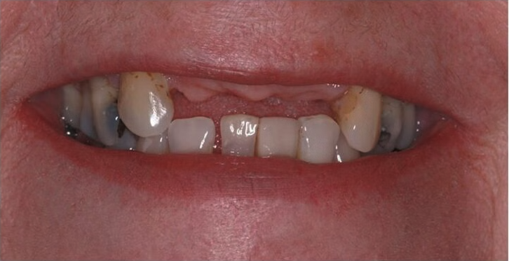 After treatment