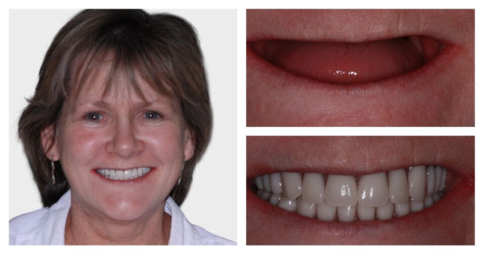 Anne Adams - Upper Dental Implants Dentist
