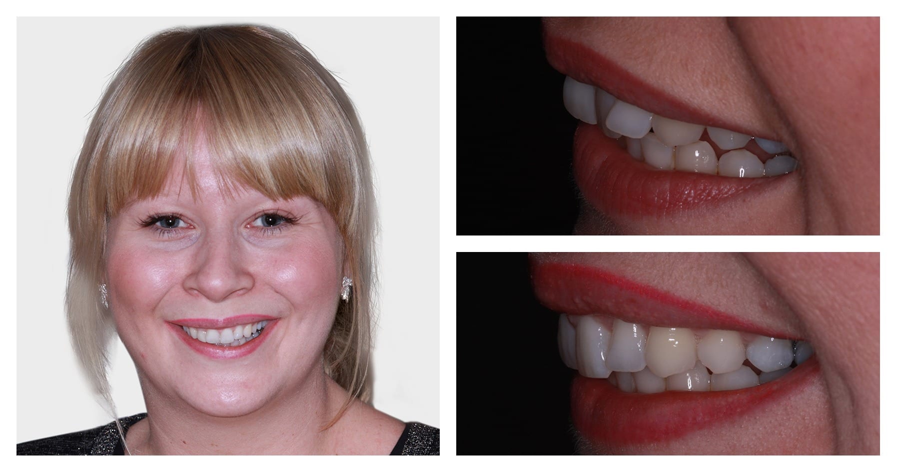 Kerry Cambell - Inman aligner