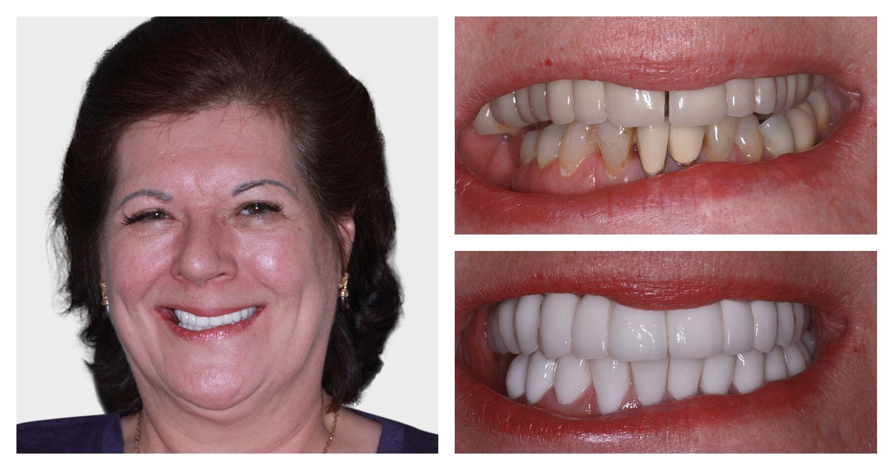 Morag Sharpe - Upper teeth Moving Dentist